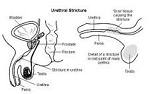 Urethral Stricture Homeopathic