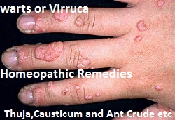 Homoeopathic remedies for warts based on location