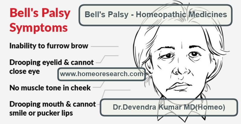 bells-palsy-homeopathy-treatment