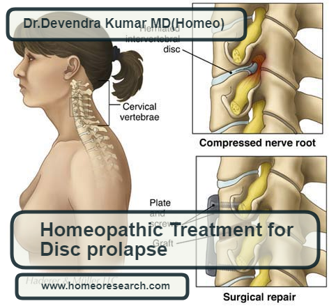 homeopathic medicines for disc prolapse