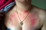 Homeopathic medicine for Urticaria