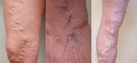 Homeopathic medicine for varicose veins