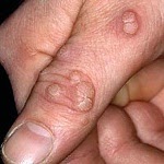 Homeopathic medicine for Warts