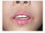 Homeopathic medicine for Stomatitis