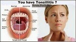 Homeopathic medicine for Tonsillitis
