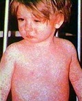 Homeopathic Medicines for Measles