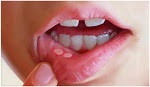 Homeopathic Medicine for mouth ulcers