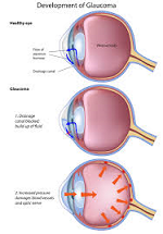 Homeopathic medicine for glaucoma