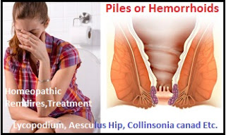 Homeopathic Remedy for Hemorrhoids