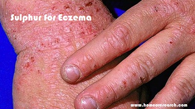 sulphur for eczema