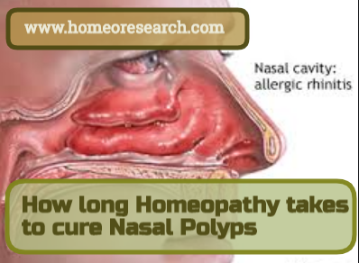 How long homeopathy takes to cure nasal polyps