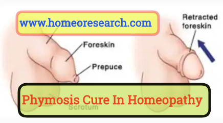 Phimosis cure in Homeopathy