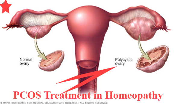 pcos treatment in homeopathy