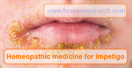Homeopathic medicine for impetigo