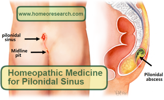 pilonidal sinus treatment in homeopathy
