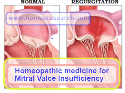 Homeopathic medicine for Mitral valve Insufficiency