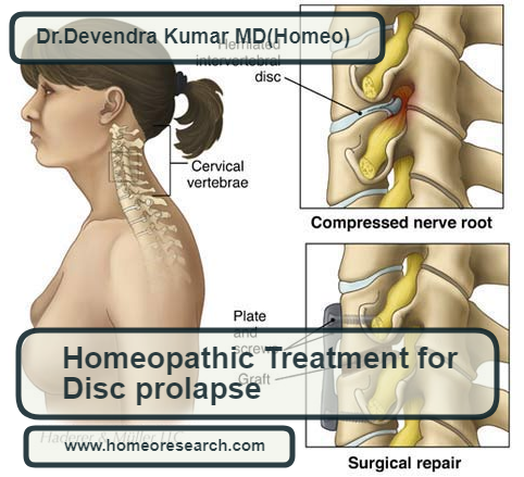 Homeopathic medicines for disc prolapse